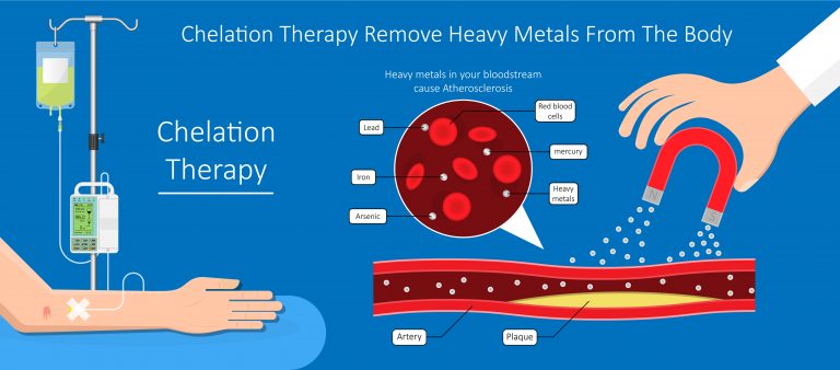 chelation therapy